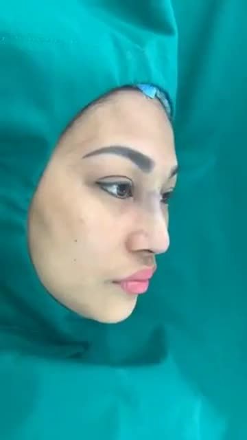 NÂNG MŨI CAO TÂY, NẠO FILLER