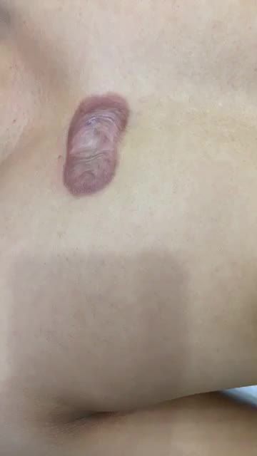 Sẹo lồi thì chữa thế nào cho đẹp