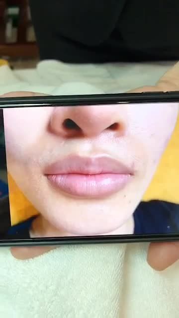 Kết quả Phun Môi  tại BVTM kangnam
