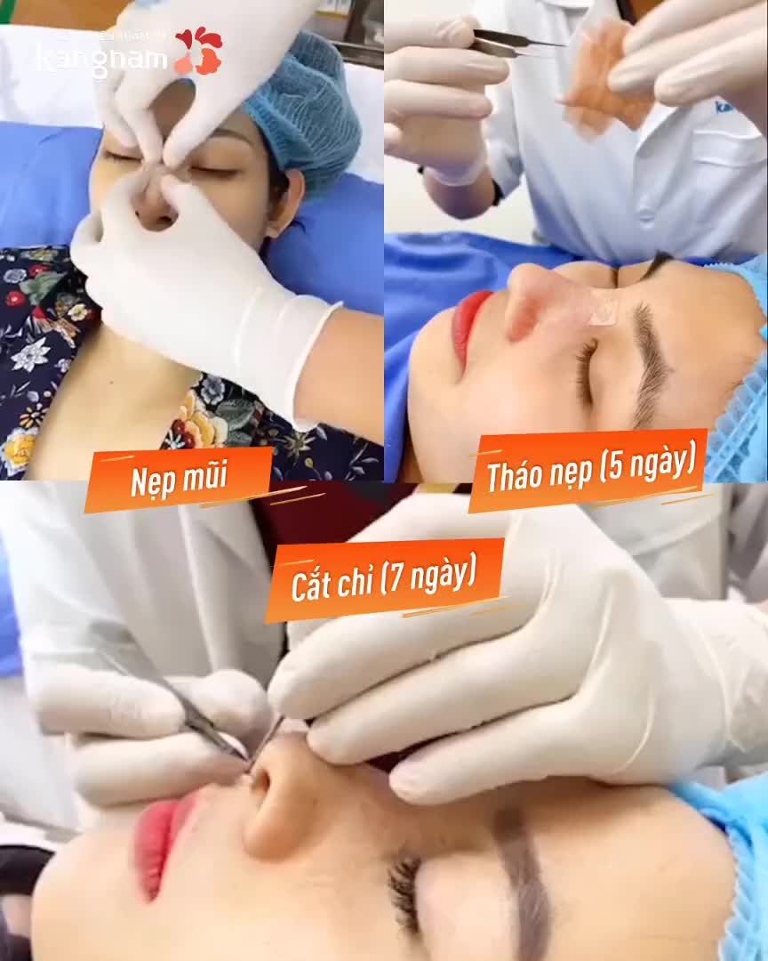 MŨI ĐẸP Chưa bao giờ đơn giản đến thế  Chỉ từ 6TR