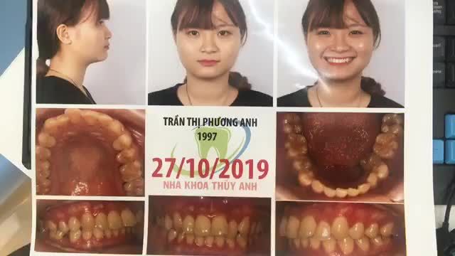 gắn mắc cài tại Nha Khoa Thuỳ Anh .