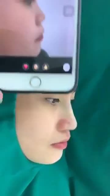 Nâng mũi bán cấu trục bọc sụn megaderm