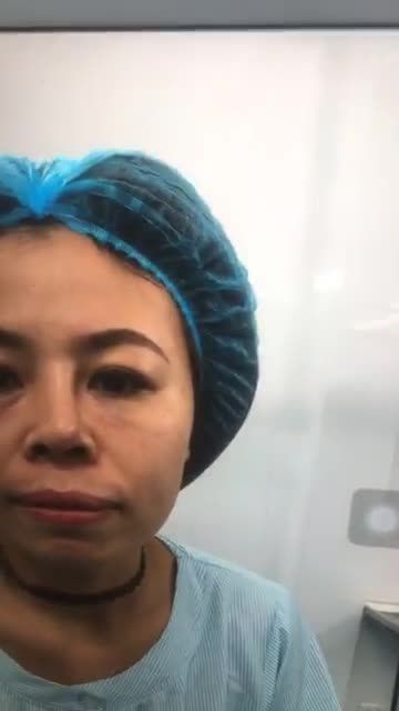 Nâng Mũi cấu trúc SOFTLINE