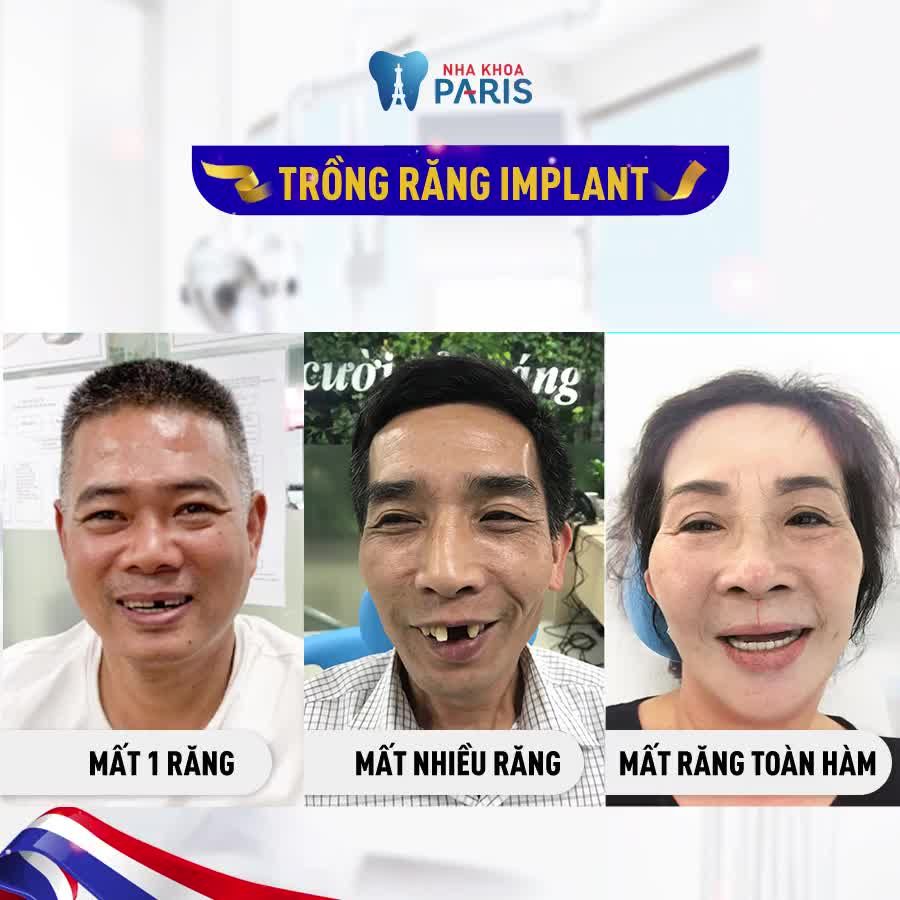 Ngày hội TRỒNG RĂNG IMPLANT tiêu chuẩn Pháp lớn nhất Sài Gòn