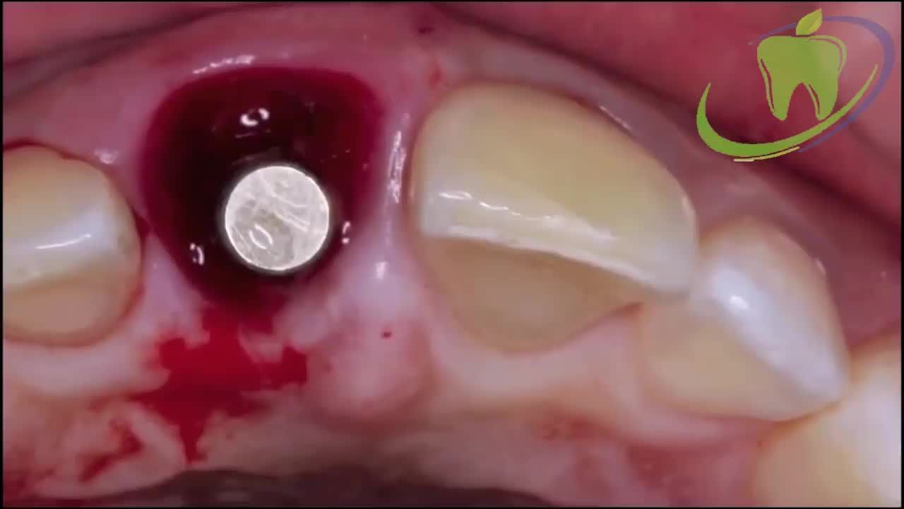 PHỤC HỒI RĂNG MẤT - TÌM LẠI SỨC KHỎE RĂNG MIỆNG TỨC THÌ