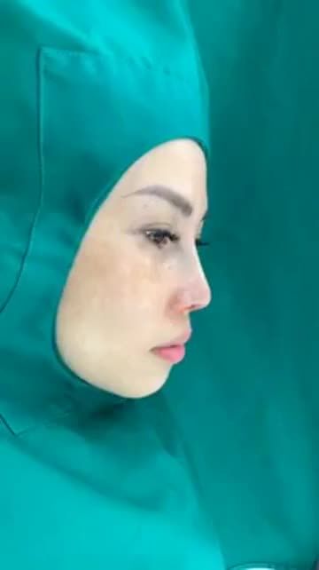 XỬ LÝ ĐẦU MŨI HẾCH, CÁNH MŨI TO