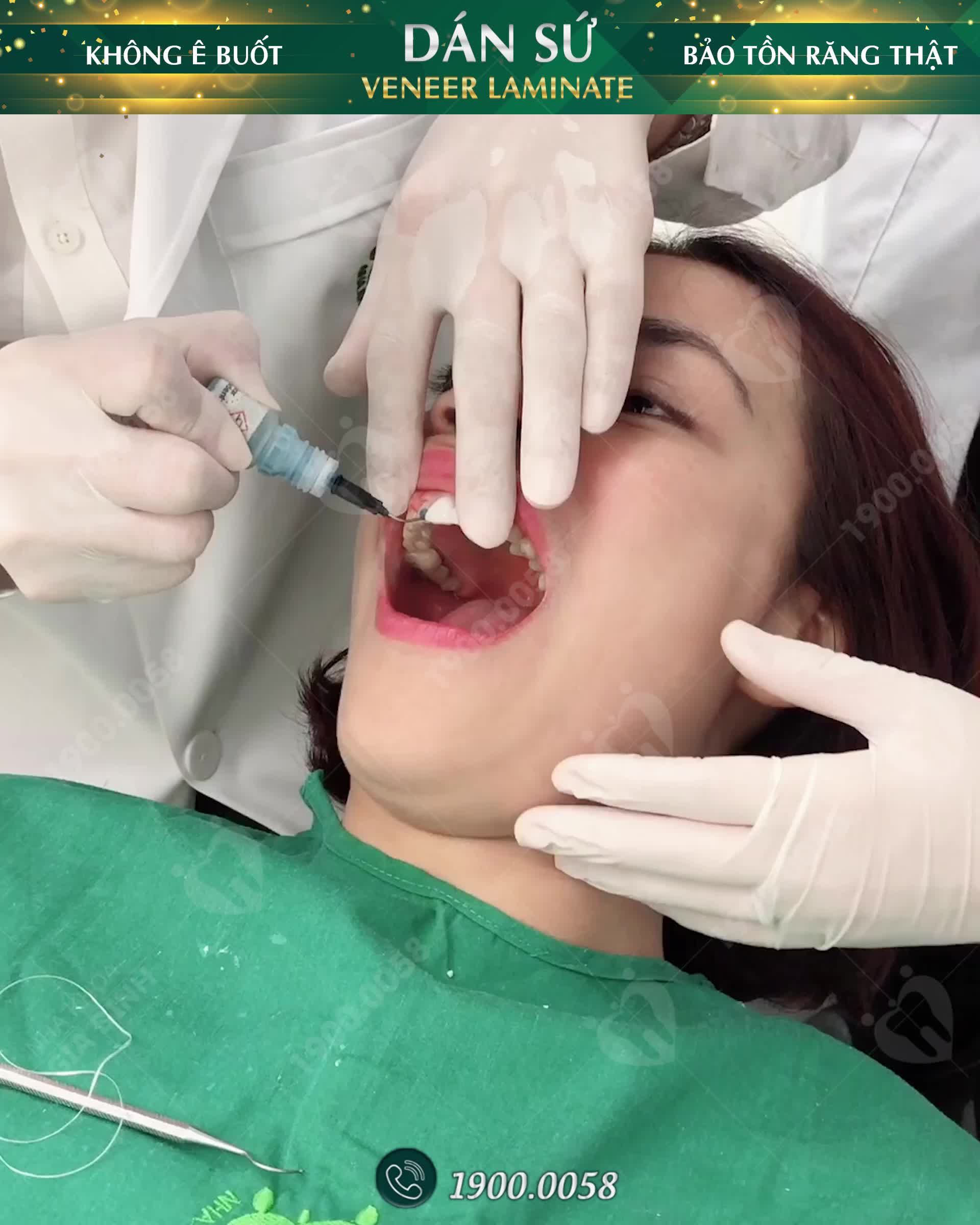 CẬN CẢNH DÁN SỨ VENEER KHÔNG MÀI NHỎ TẠI NHA KHOA GIA ĐÌNH