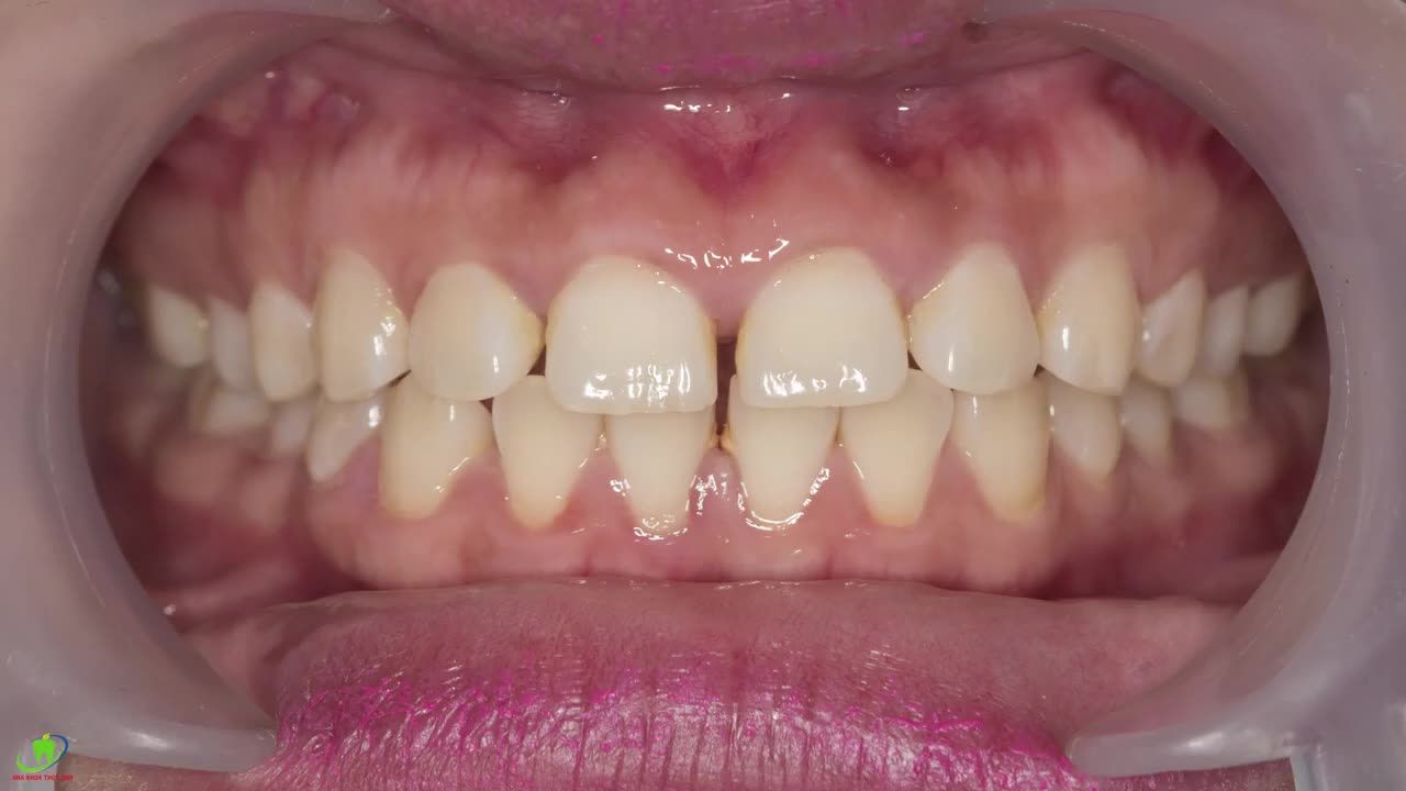 NỤ CƯỜI THÊM XINH SAU KHI DÁN SỨ VENEER