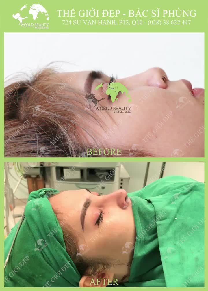 Cải thiện mũi Ngắn Hếch có khó không. Giải pháp nào tối ưu để lựa chọn