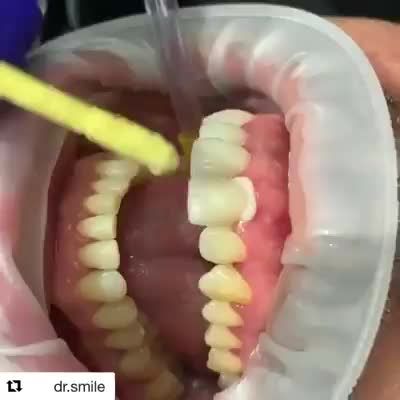 Hình ảnh dán Veneer