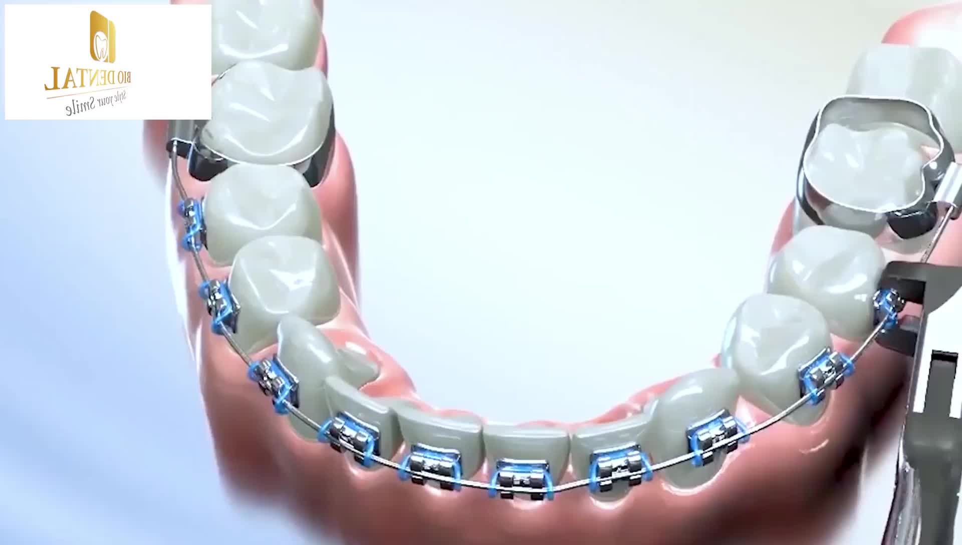 QÚA TRÌNH THÁO NIỀNG RĂNG