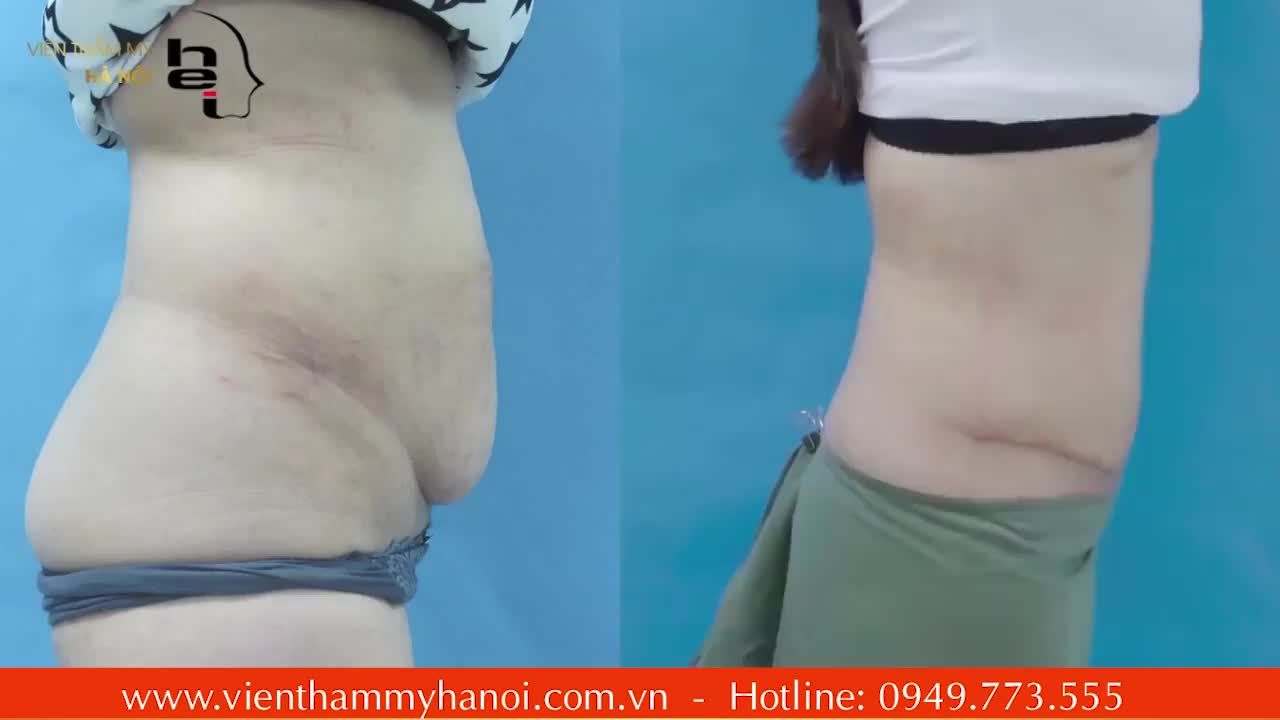 TẠO HÌNH THÀNH BỤNG - KHÔNG CÒN NHỚ NHUNG DÁNG THỜI CÒN XUÂN