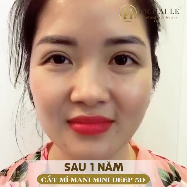 Đôi mắt sau 1 năm cắt mí trông sẽ như thế nào? Chắc chắn bạn sẽ bất ngờ về điều này.
