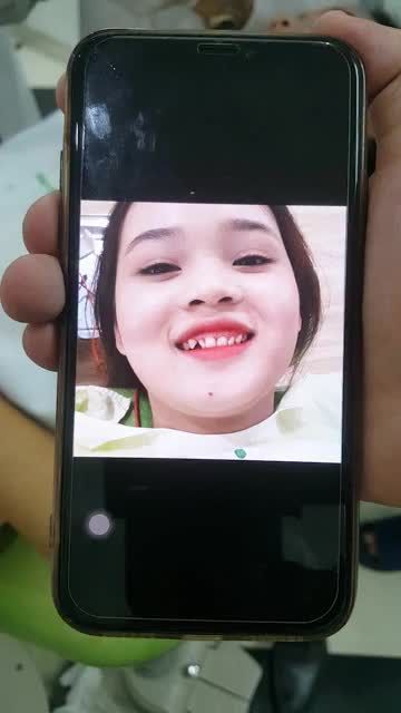 Ca Dán 22 Veneer Sứ - Bạn Nguyễn Hải Linh tại chi nhánh 16 Trần Thái Tông