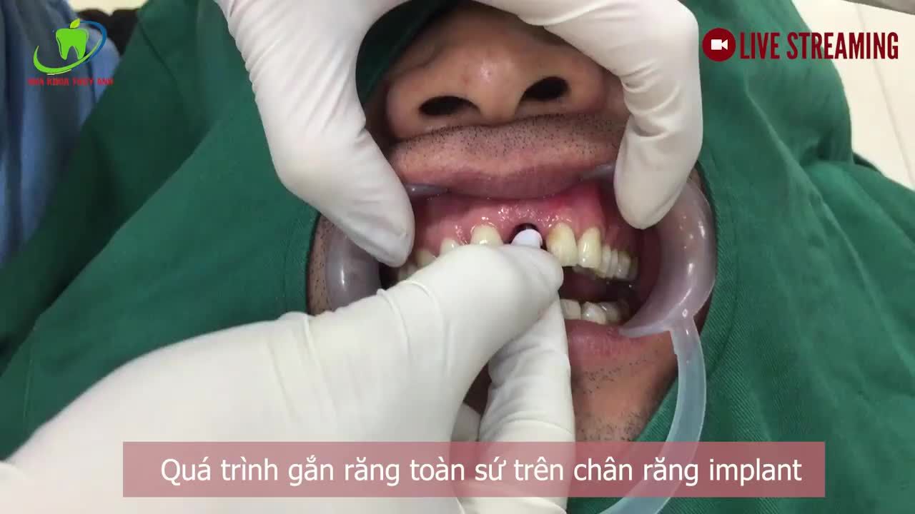 RĂNG SỨ TRỒNG TRÊN CHÂN RĂNG IMPLANT CÓ GÌ KHÁC