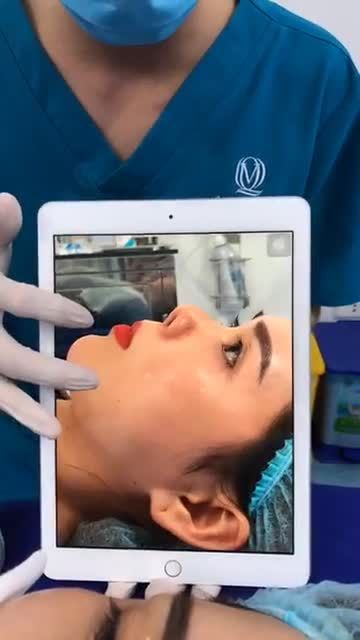 Bác sĩ vừa thực hiện xong 1 ca MŨI SỬA siêu khó sau nhiều giờ đồng hồ