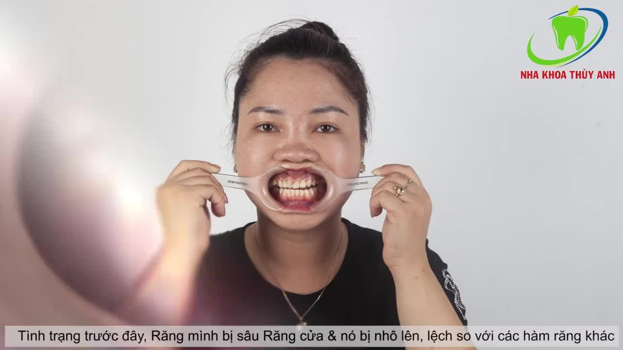 BỌC RĂNG SỨ - BÍ MẬT LƯU GIỮ NỤ CƯỜI CỦA PHÁI ĐẸP