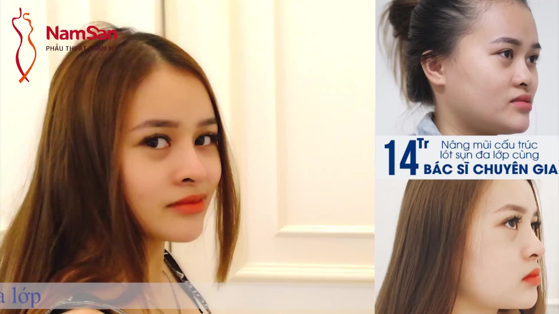 DÁNG MŨI THẦN THÁI CỦA THÚY VI SAU 10 NGÀY THỰC HIỆN