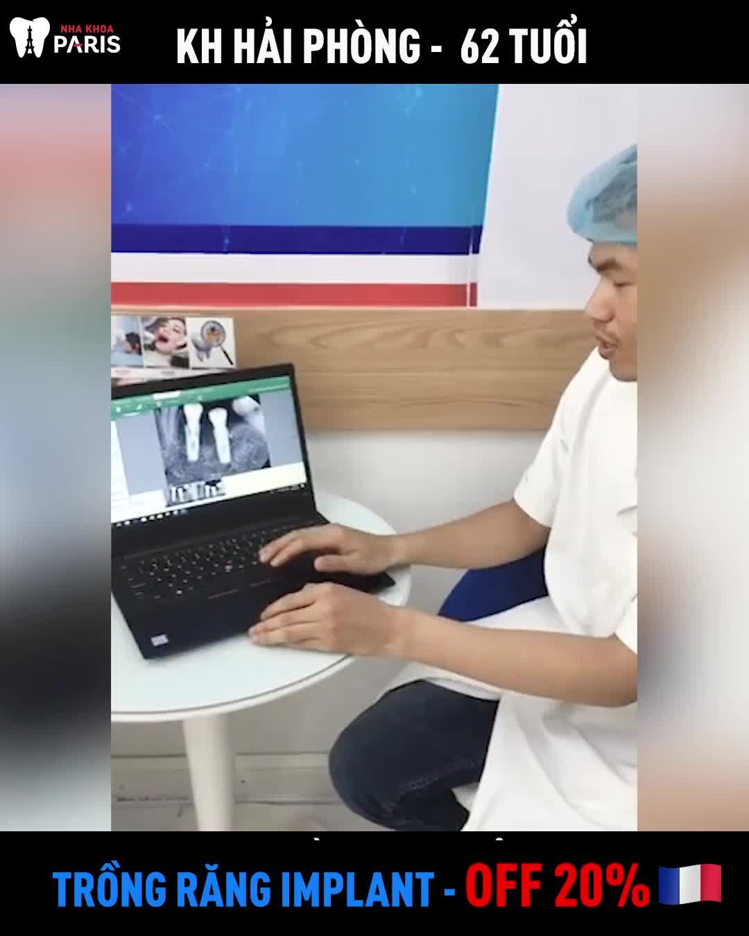 62 TUỔI TRỒNG RĂNG IMPLANT ALL ON TOÀN HÀM  CÁI KẾT