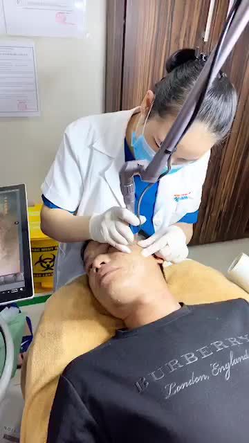 Cải thiện 90 % Sẹo khên khuân mặt sau 5 buổi điều trị với công nghệ Laser Fractional