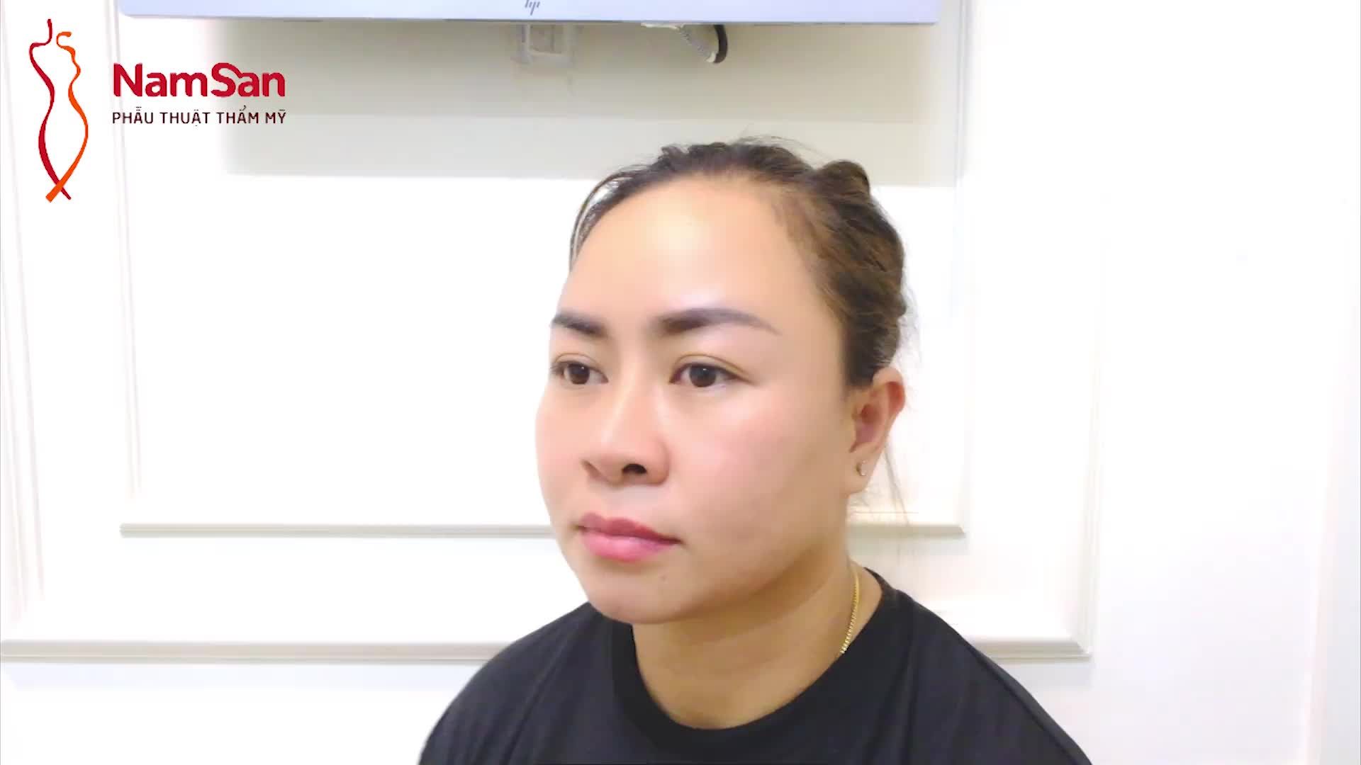 Đây là kết quả của một ca phẫu thuật nâng mũi siêu cấu trúc và cắt cánh mũi của chị Kim Võ, được thực hiện sáng nay tại NamSan