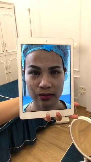 Tiếp tục với ca MŨI SỬA pureform của ekip bác sĩ đây ạ