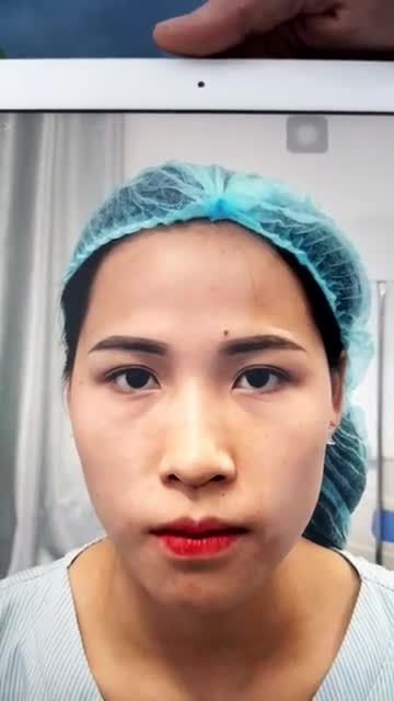 Chiều muộn với một ca cắt mí trên + mở góc mắt trong