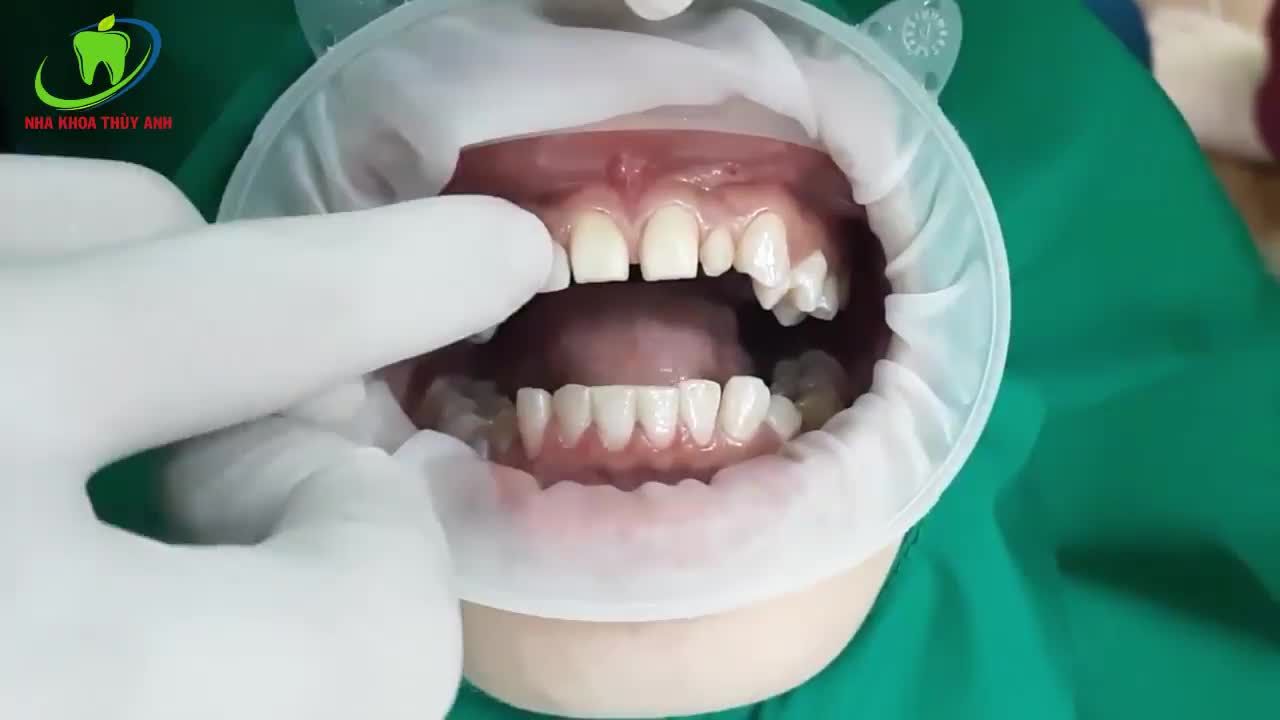 DÁN SỨ VENEER - BẬT MÍ SỞ HỮU NỤ CƯỜI HOÀN HẢO HƠN