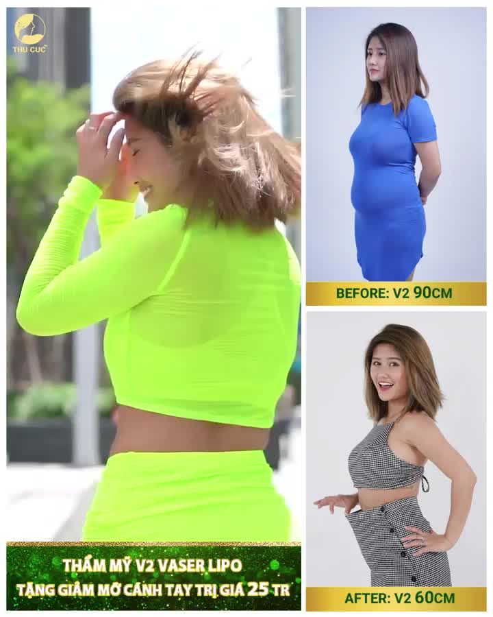 "Vòng eo con kiến" ĐẸP RẠNG NGỜI cùng với Thẩm mỹ V2 Vaser Lipo  Vòng eo GIẢM từ 90cm xuống 60 cm
