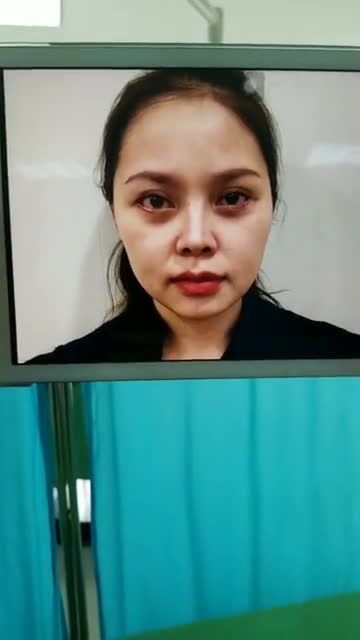 Chị gái xinh yêu vừa độn góc mũi xong, mời cả nhà vào xem cùng Viện thẩm mỹ Hà Nội