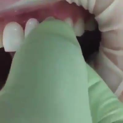 Đây là lý do vì sao nên thẩm mỹ răng với SKIN VENEER