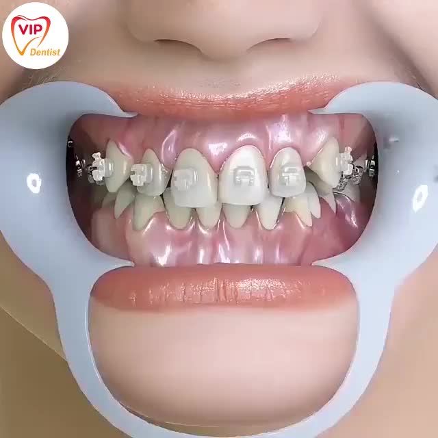 Niềng răng cho hàm răng thay đổi, khuôn mặt trông cũng sẽ khác hẳn: mặt thu gọn, cằm trông dài ra, môi nhìn sắc nét.