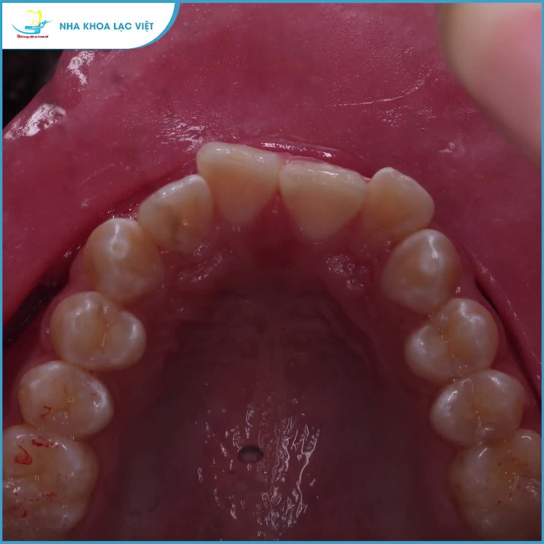 NIỀNG RĂNG XONG ĐẸP TRAI CỠ NÀO