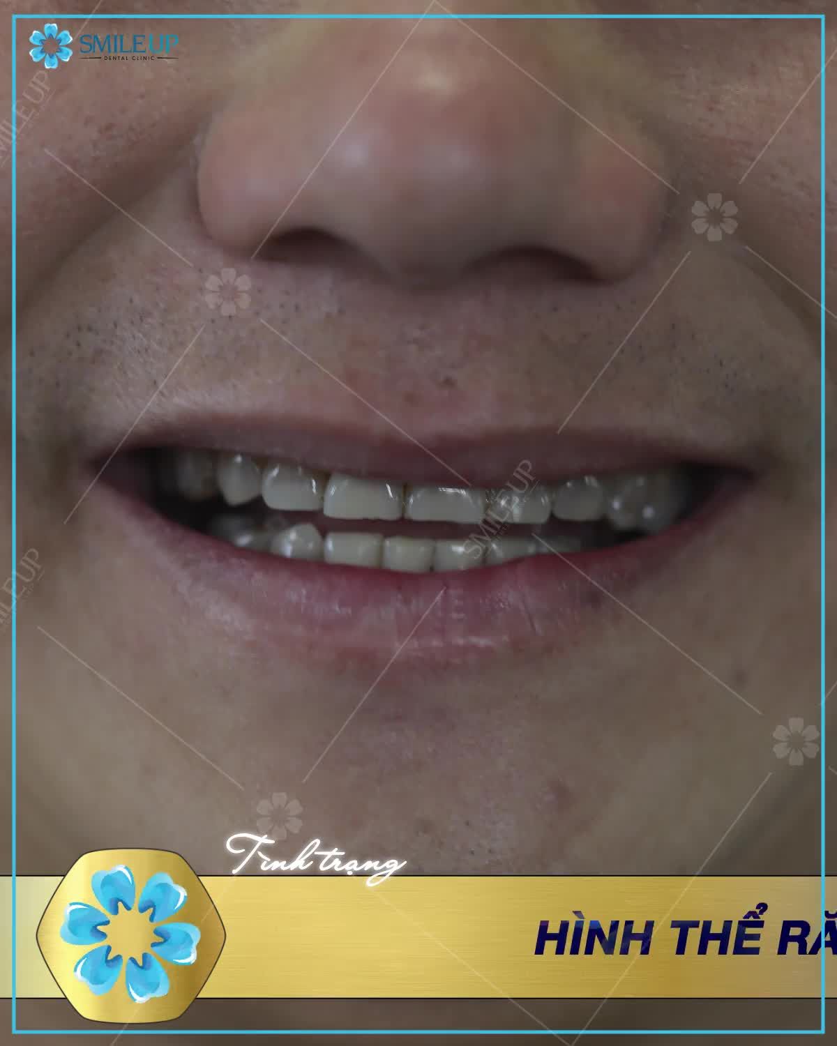 RĂNG SỨ CHUẨN THẨM MỸ- CHUẨN AN TOÀN- KHÔNG SMILE UP THÌ Ở ĐÂU