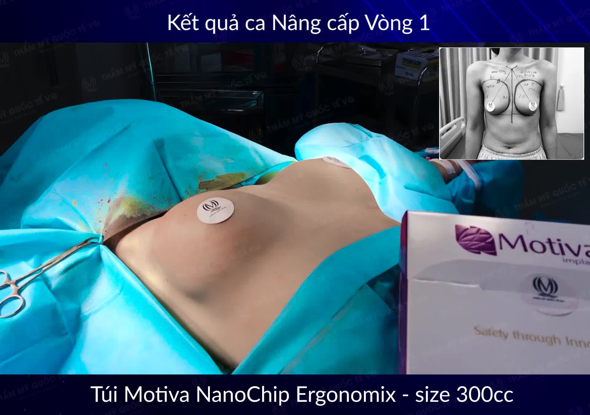 Chị khách hàng chỉ biết gật đầu sau khi nhìn thấy vòng 1 của mình được tân trang lại.