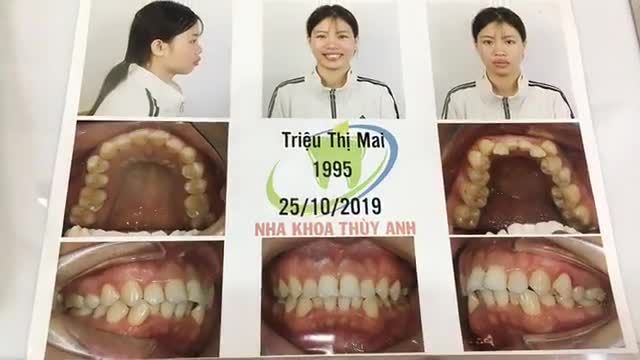 GĂN MẮC CÀI TẠI NHA KHOA THÙY ANH