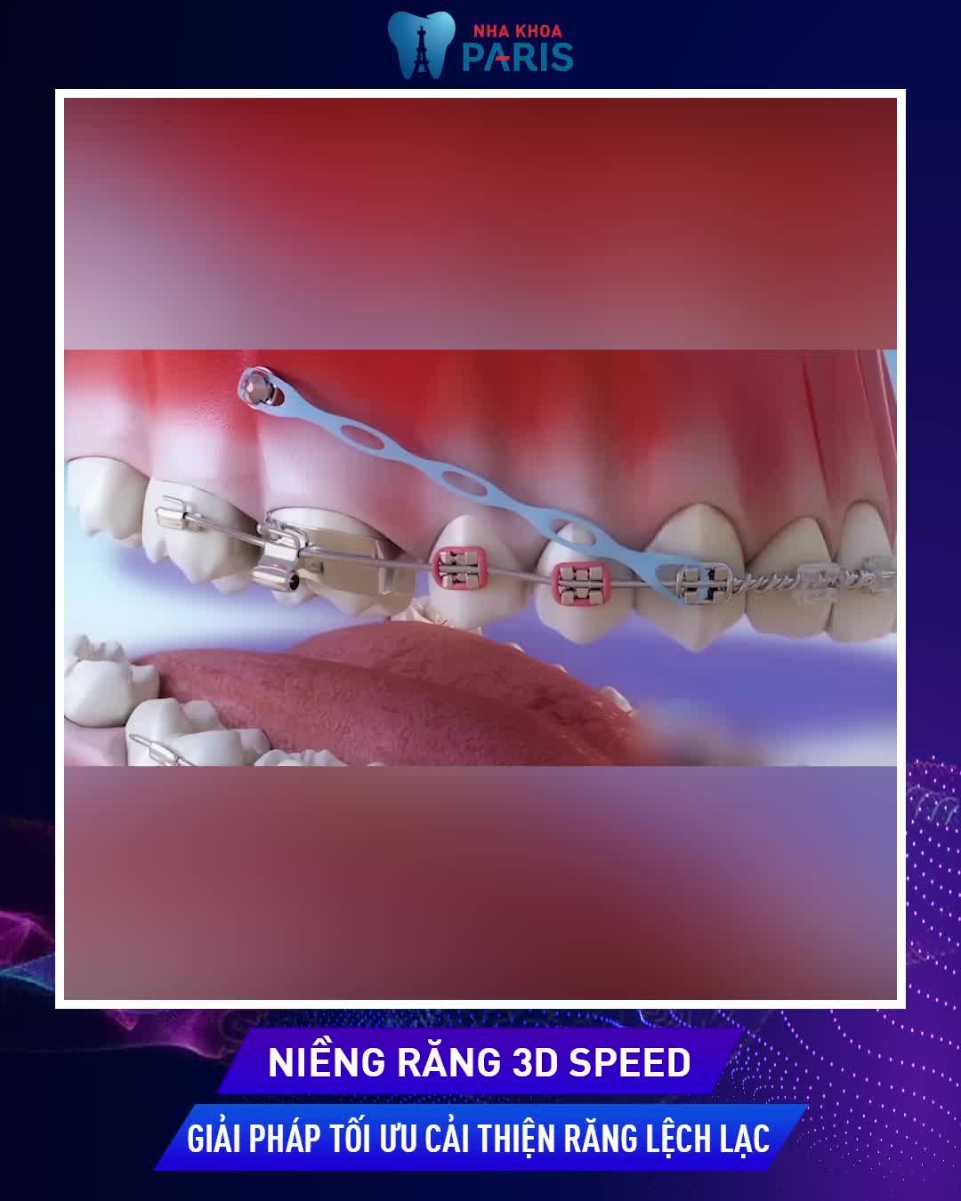 Hàm răng xấu xí Mất thẩm mỹ