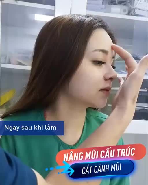NÂNG MŨI CẤU TRÚC 4D - Tặng ưu đãi đến 30%