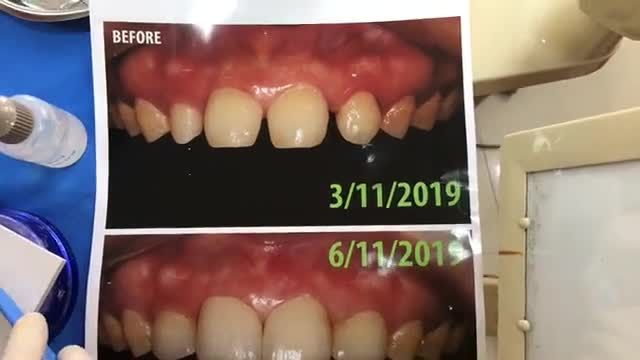Ca gắn 4 răng sứ thẩm mỹ chỉnh sửa tình trạng răng thưa cho khách hàng.