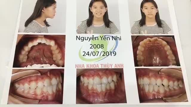 Gắn mắc cài cho bạn Nhi tại Nha Khoa Thùy Anh.
