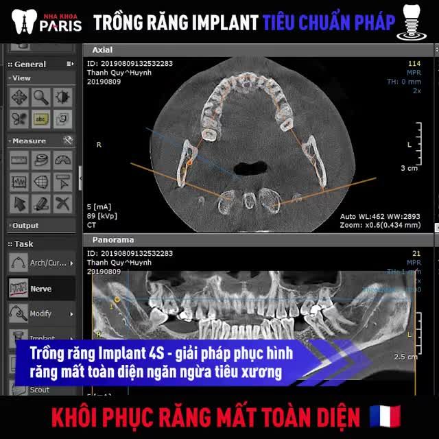 Về Việt Nam khôi phục răng mất, tại sao không?