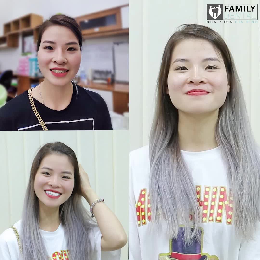 THẨM MỸ RĂNG TẠI NHA KHOA GIA ĐÌNH CÓ GÌ KHÁC BIỆT?