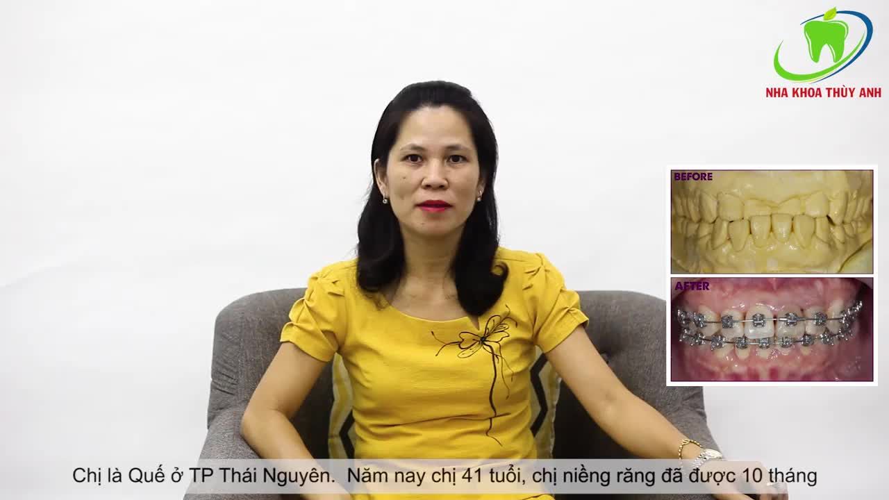 NIỀNG RĂNG HOÀN THIỆN NỤ CƯỜI KHÔNG PHÂN BIỆT TUỔI TÁC