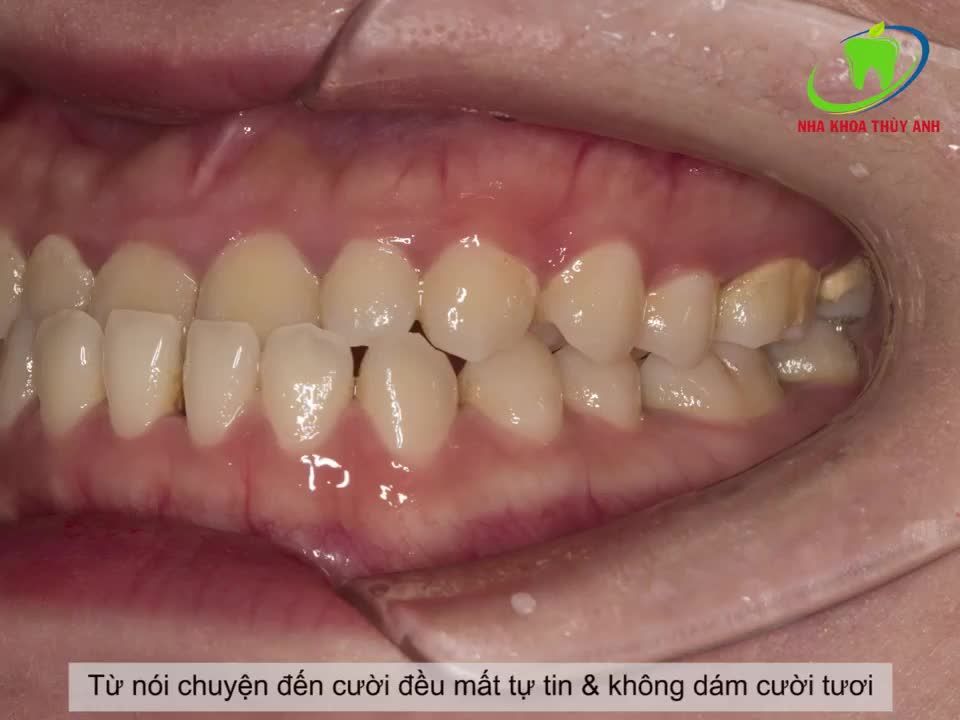 ĐỪNG CHẦN CHỜ NỮA HÃY ĐỂ NIỀNG RĂNG GIÚP BẠN SỞ HỮU NỤ CƯỜI HOÀN HẢO HƠN