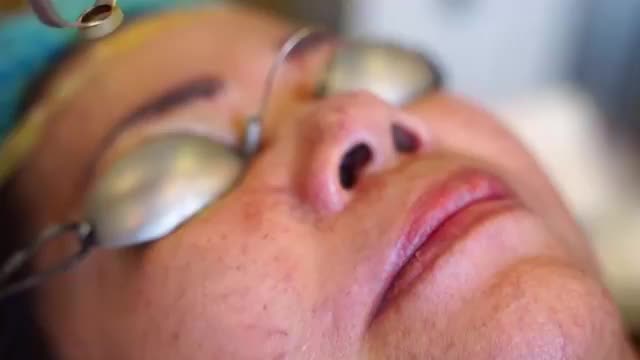 Mời cả nhà cùng theo dõi một ca điều trị GIÃN MAO MẠCH tại DR. HẢI LÊ