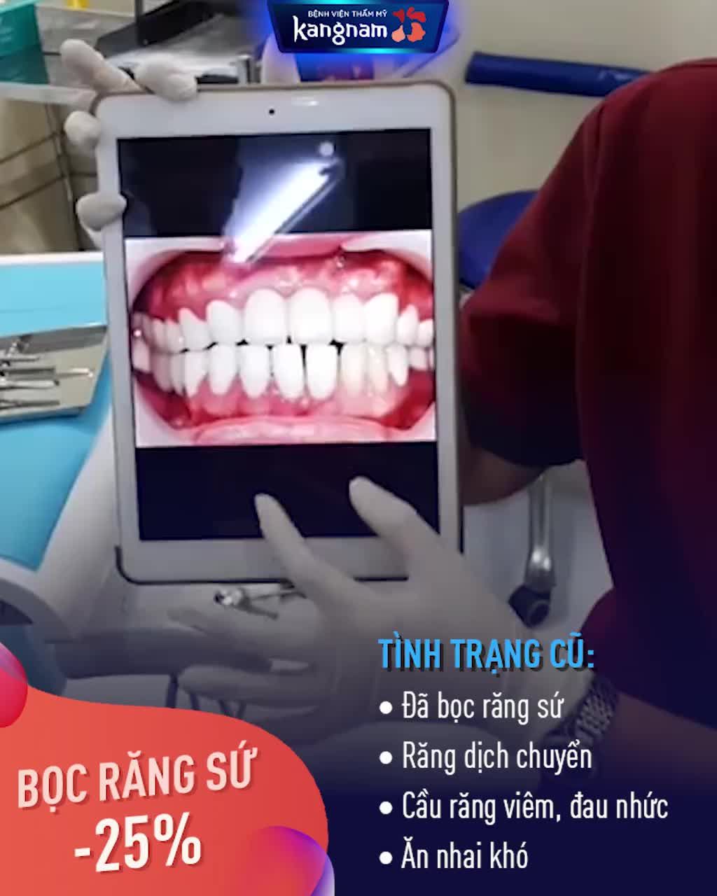 BỌC RĂNG SỨ CHỈ từ 4,5TR