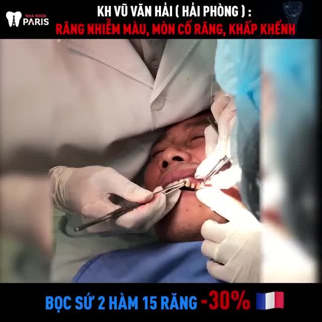 Ca gắn răng hoàn thiện Bọc Sứ cho Chú Hải (Hải Phòng)