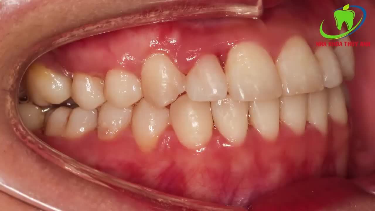 MẠNH DẠN NIỀNG RĂNG ĐỂ SỞ HỮU NỤ CƯỜI TỰ TIN