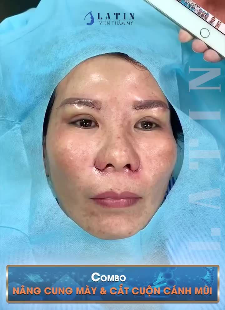 COMBO Nâng cung mày + Cắt cuộn cánh mũi cho chị khách ở Cà Mau.