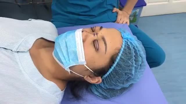 Cùng Ekip Dr. Vũ Quang nhìn lại gương mặt cũ trước khi làm của chị khách hàng nhé cả nhà !